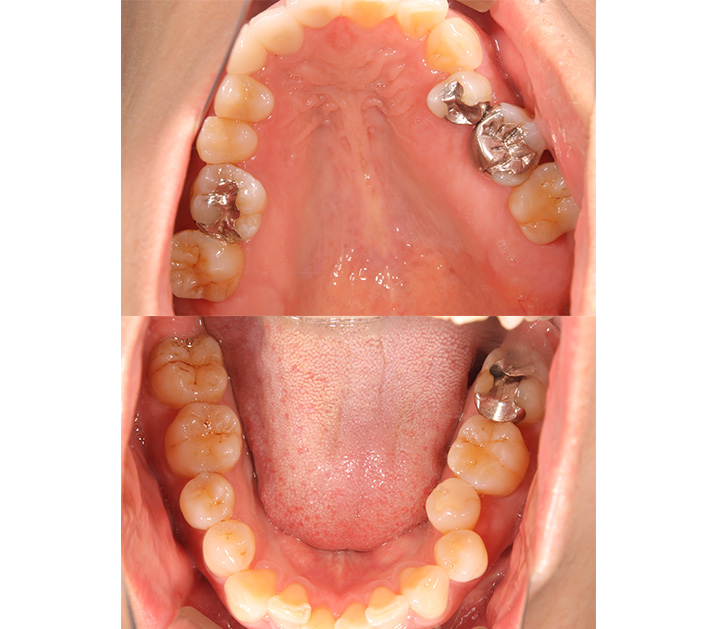 咬合力の強い症例に対しセラミクスとジルコニアで対応したケースbefore