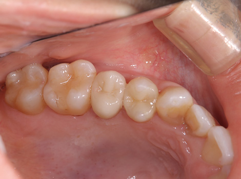 う蝕に対してメタルフリーで修復したケースafter