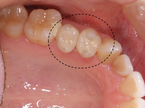 う蝕に対してメタルフリーで修復したケースbefore