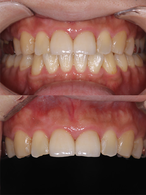 前歯の広範なう蝕に対しプラークコントロールを行い審美的に補綴したケースafter