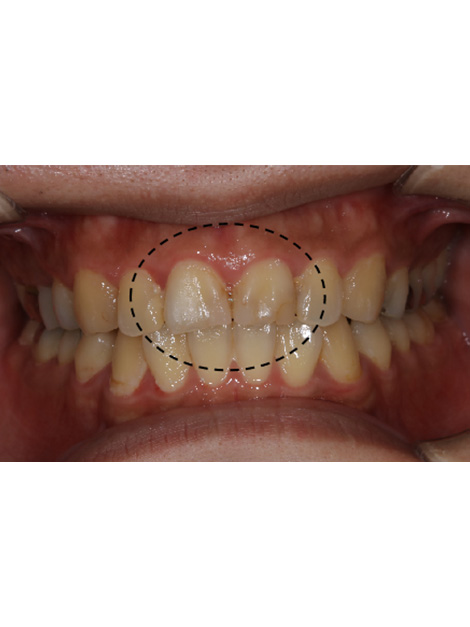 前歯の広範なう蝕に対しプラークコントロールを行い審美的に補綴したケースbefore