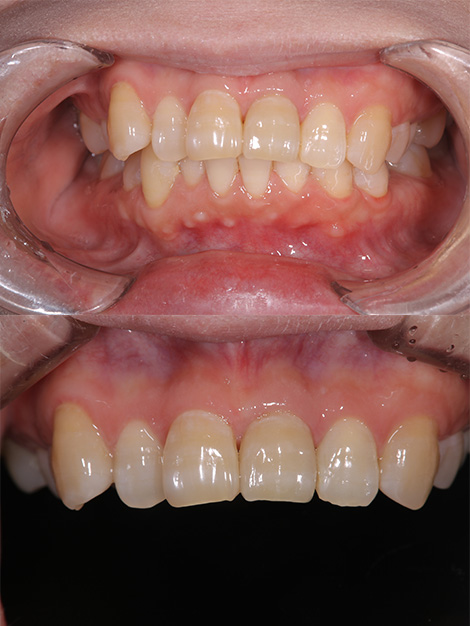 歯周外科と部分矯正で天然歯を保存し、ジルコニアセラミクスクラウンでインプラントを回避したケースafter
