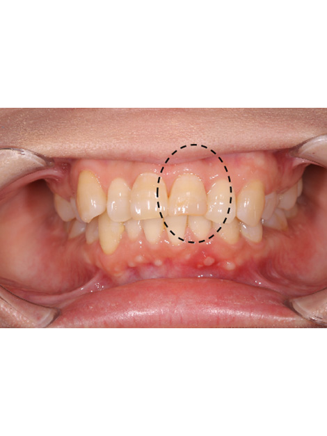 歯周外科と部分矯正で天然歯を保存し、ジルコニアセラミクスクラウンでインプラントを回避したケースbefore