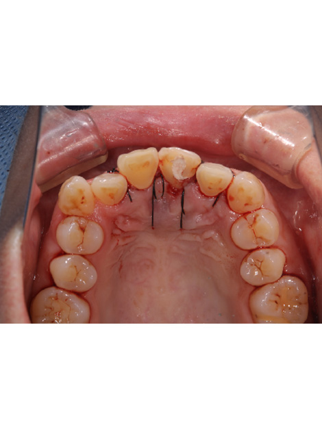 歯周外科と部分矯正で天然歯を保存し、ジルコニアセラミクスクラウンでインプラントを回避したケースbefore