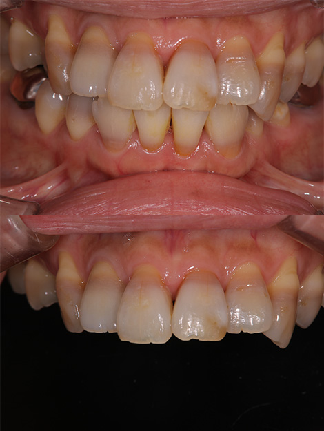 前歯の審美障害をブリーチングとジルコニアセラミクスクラウンで周囲の歯牙と調和させたケースafter
