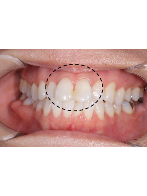 前歯の審美障害をダイレクトボンディングとジルコニアセラミクスクラウンで調和させたケースbefore
