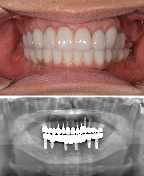 他院で予後不良だった歯根端切除術後の治療をインプラントで全顎的に行ったケースafter