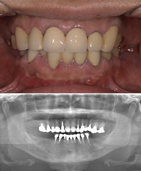 他院で予後不良だった歯根端切除術後の治療をインプラントで全顎的に行ったケースbefore