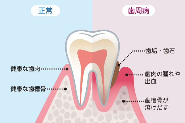進行した歯周病と治った歯周病の図(あれば挿入)